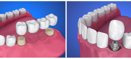 Разница между имплантом, коронкой и мостом